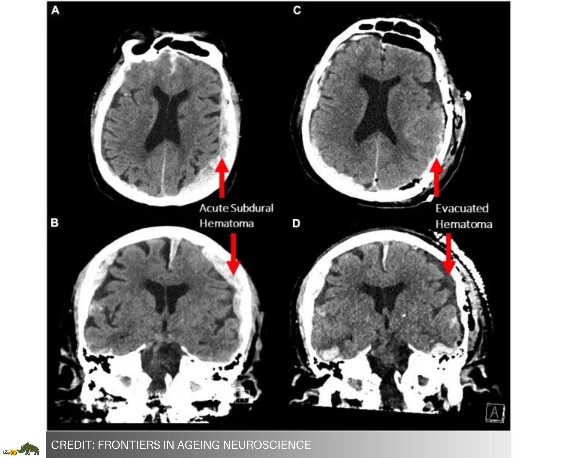 نتایج شگفت‌انگیز یک تحقیق؛ زمان مرگ دقیقا چه اتفاقی می‌افتد؟
