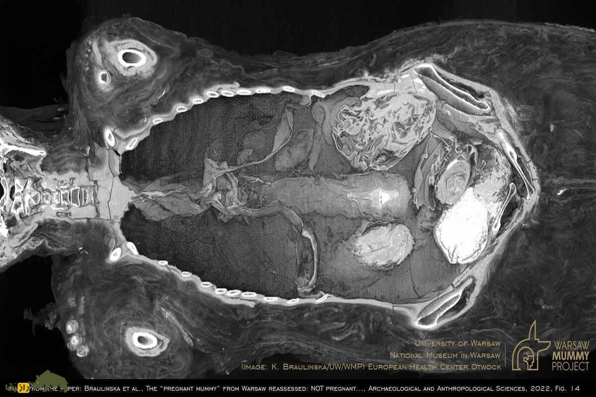 مومیایی باردار ورشو: کشفی تاریخی و رازهای آن مومیایی باردار ورشو: کشفی تاریخی و رازهای آن