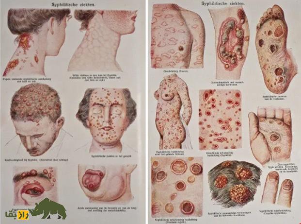 سیفلیس: ترسناکترین بیماری مقاربتی نیمهزاره گذشته از کجا آمد؟ سیفلیس: ترسناکترین بیماری مقاربتی نیمهزاره گذشته از کجا آمد؟