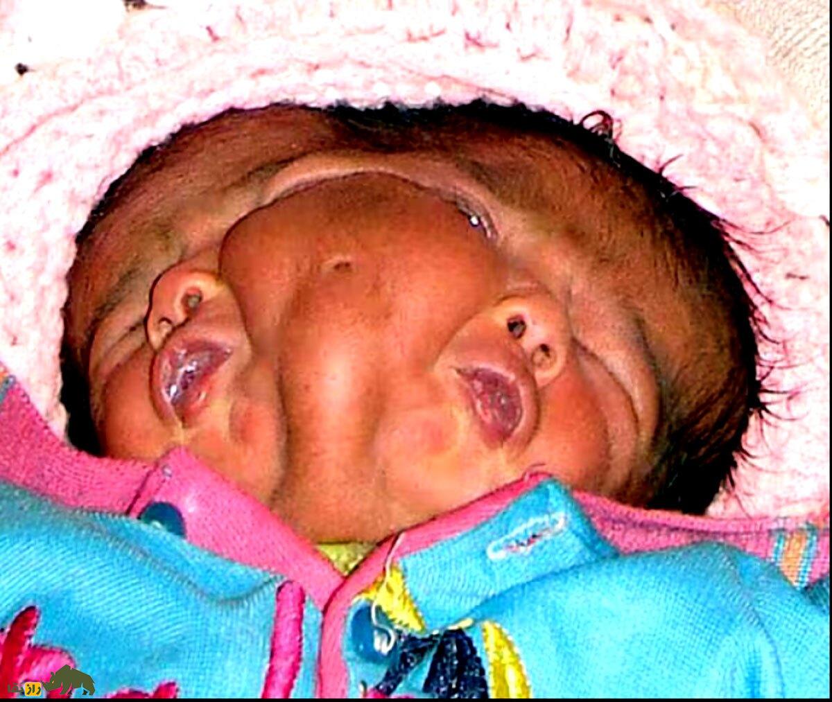 (تصاویر) تولد نوزادی با چهار چشم و دو دماغ و یک ناف در وسط صورت!