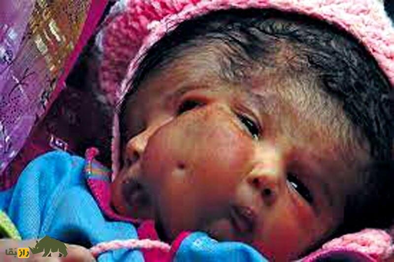 (تصاویر) تولد نوزادی با چهار چشم و دو دماغ و یک ناف در وسط صورت!