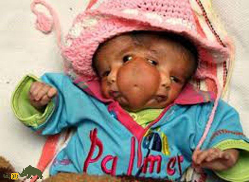 (تصاویر) تولد نوزادی با چهار چشم و دو دماغ و یک ناف در وسط صورت!