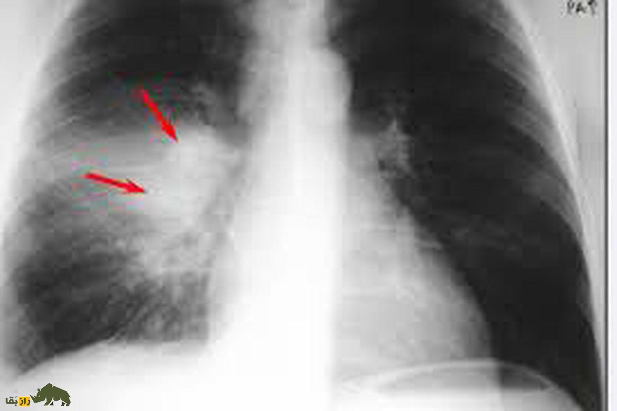 تصویر ایکس ری از ریه