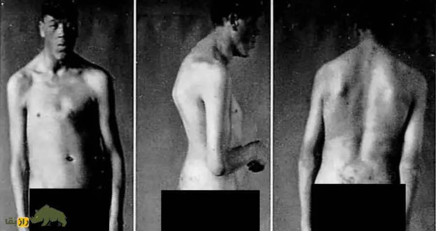 آدام راینر؛ مردی که کوتوله به دنیا آمد و غول از دنیا رفت! رشد عجیب او هنوز یکی از معماهای پزشکی است آدام راینر؛ مردی که کوتوله به دنیا آمد و غول از دنیا رفت! رشد عجیب او هنوز یکی از معماهای پزشکی است