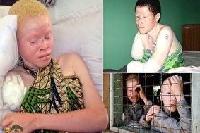 تصاویر +۱۸ از قتلهای وحشیانه افراد زال در آفریقا بهخاطر باورهای جادویی، نفرین و طلسمهای مرگبار