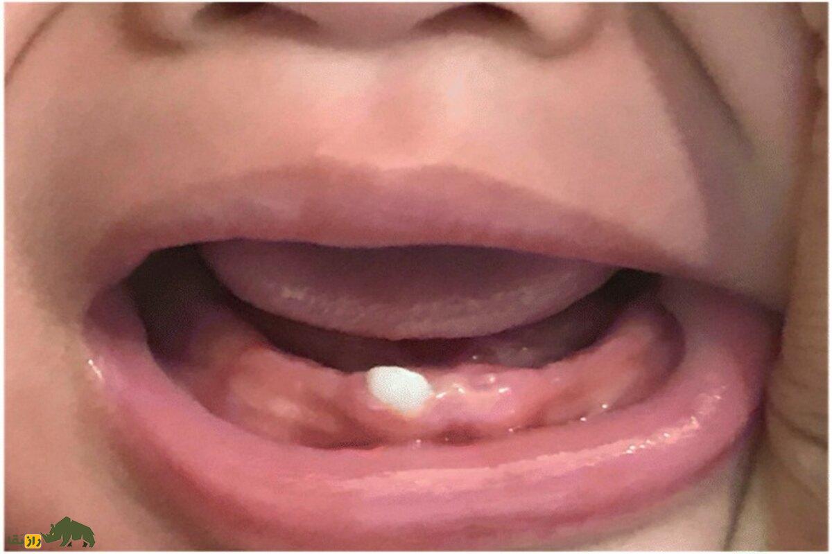 دندان ناتال نوزاد؛ تهدیدی پنهان برای جان کودک و مادر | علت، خطرات و روش درمان علمی را بخوانید