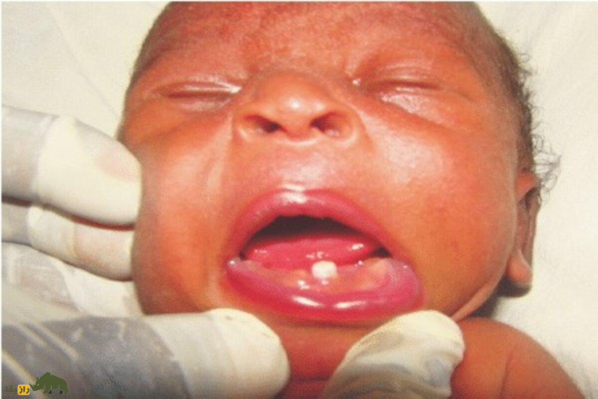 دندان ناتال نوزاد؛ تهدیدی پنهان برای جان کودک و مادر | علت، خطرات و روش درمان علمی را بخوانید