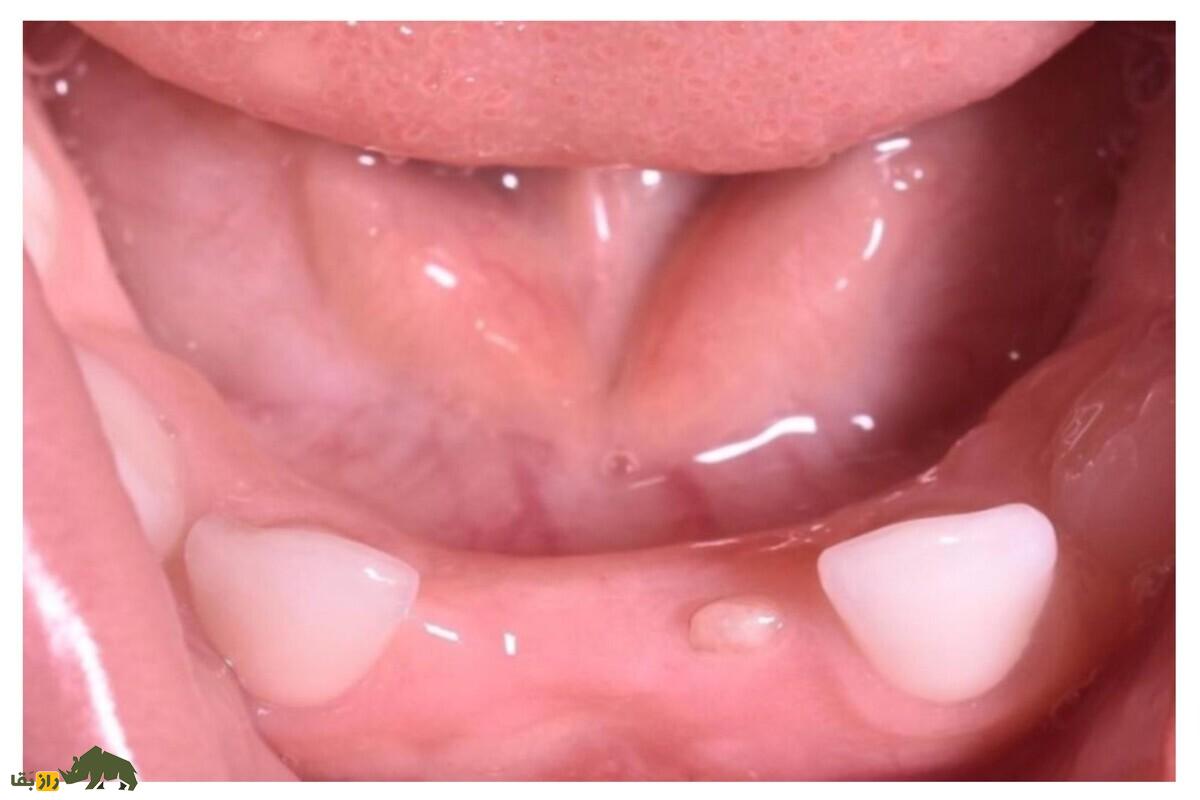 دندان ناتال نوزاد؛ تهدیدی پنهان برای جان کودک و مادر | علت، خطرات و روش درمان علمی را بخوانید