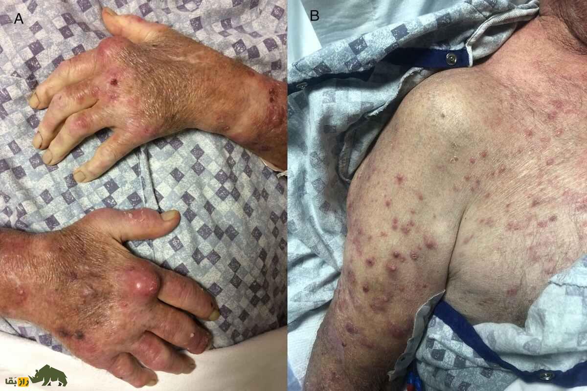 (تصاویر +۱۸) چهار کشته در فلوریدا بر اثر باکتری گوشتخوار؛ هشدارها و وضعیت این باکتری در ایران (تصاویر +۱۸) چهار کشته در فلوریدا بر اثر باکتری گوشتخوار؛ هشدارها و وضعیت این باکتری در ایران