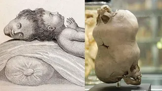 پسری که دو سر داشت؛ داستان واقعی عجیب‌ترین کودک بنگال که ۲۴۰ سال بعد هنوز می‌توان جمجمه او را دید